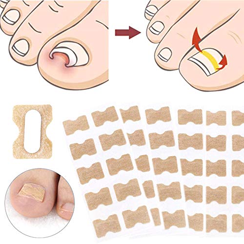 Juego de 5 parches de uñas sin pegamento – Kit de herramientas encarnadas para uñas de los pies para tratamiento de uñas, herramienta de corrección de uñas encarnadas para eliminar las uñas de los pies remiendo profesional para mantener las uñas saludable 6