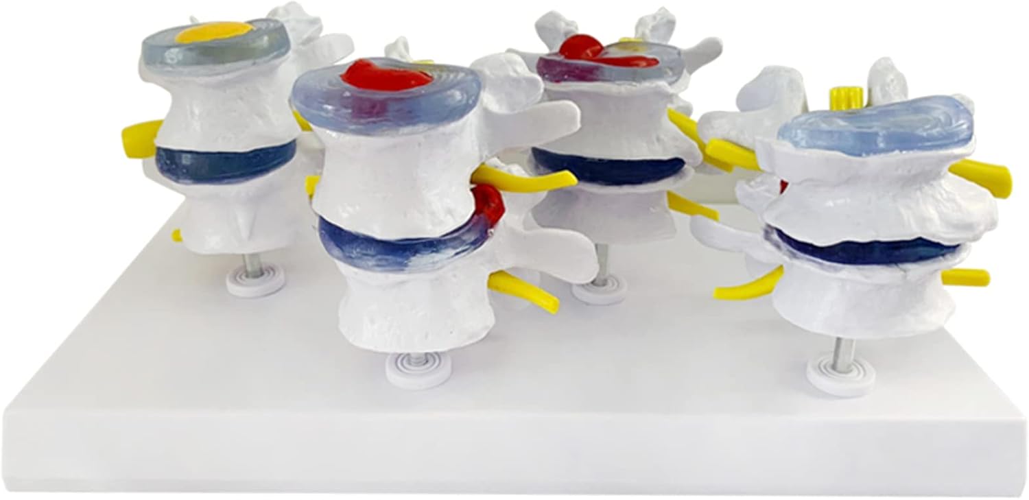 KH66ZKY Lumbar Human Spine Model Human Anatomical Lumbar Disc Herniation Model