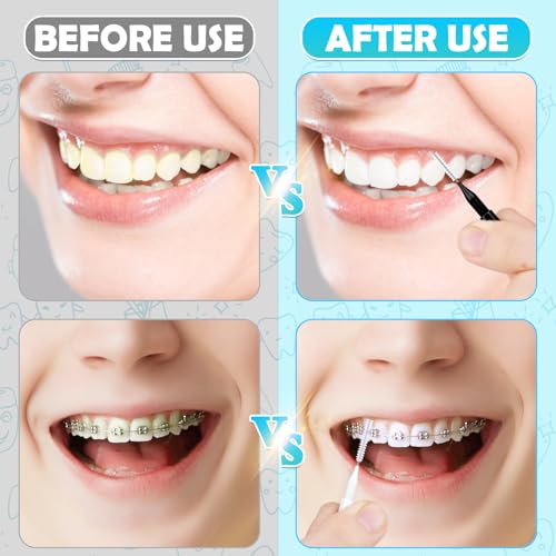 Image of MAPVOLUT 120Pcs Interdental Brush, Braces Brush Toothpicks with Soft Bristles 360 Bendable Floss Heads Dental Brushes Between Teeth Gum Braces Cleaning Kit Oral Tooth Cleaning Tool (Black, White)