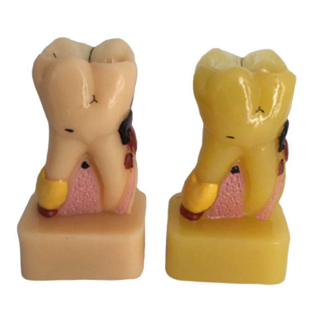 Modèle De Soins Dentaires - Modèle Anatomique des Dents - Modèle Dentaire Complet De Pathologie - Matériel en Résine Modèle De Dents Dentaires - pour L'Affichage D'Étude (B)
