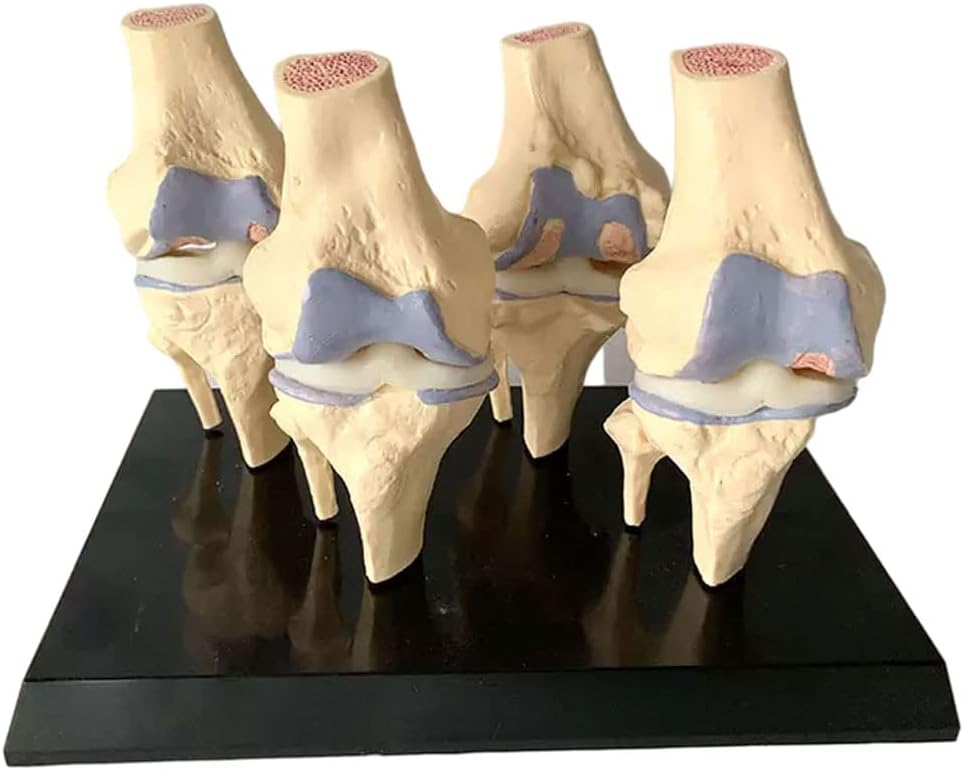 Knee Joint Model Set, 4-Stage Human Knee Joint Comparison Model, for Pathology Explanation Teaching, Medical Teaching Demonstration