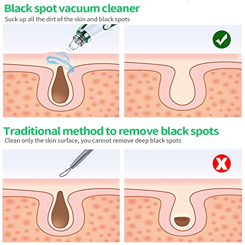 2023-Newest-Blackhead-Remover-Pore-VacuumUpgraded-Facial-Pore-CleanerElectric-Acne-Comedone-Whitehead-Extractor-Tool-5-Suction-Power5-ProbesUSB-Rechargeable-Blackhead-Vacuum-Kit-for-Women-Men