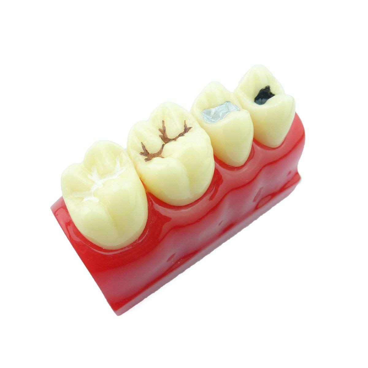 Modello di denti dentali per allenamento orale, chiusura a fessura e scanalatura, strumento educativo per anatomia umana, studio medico e simulatore di pratica