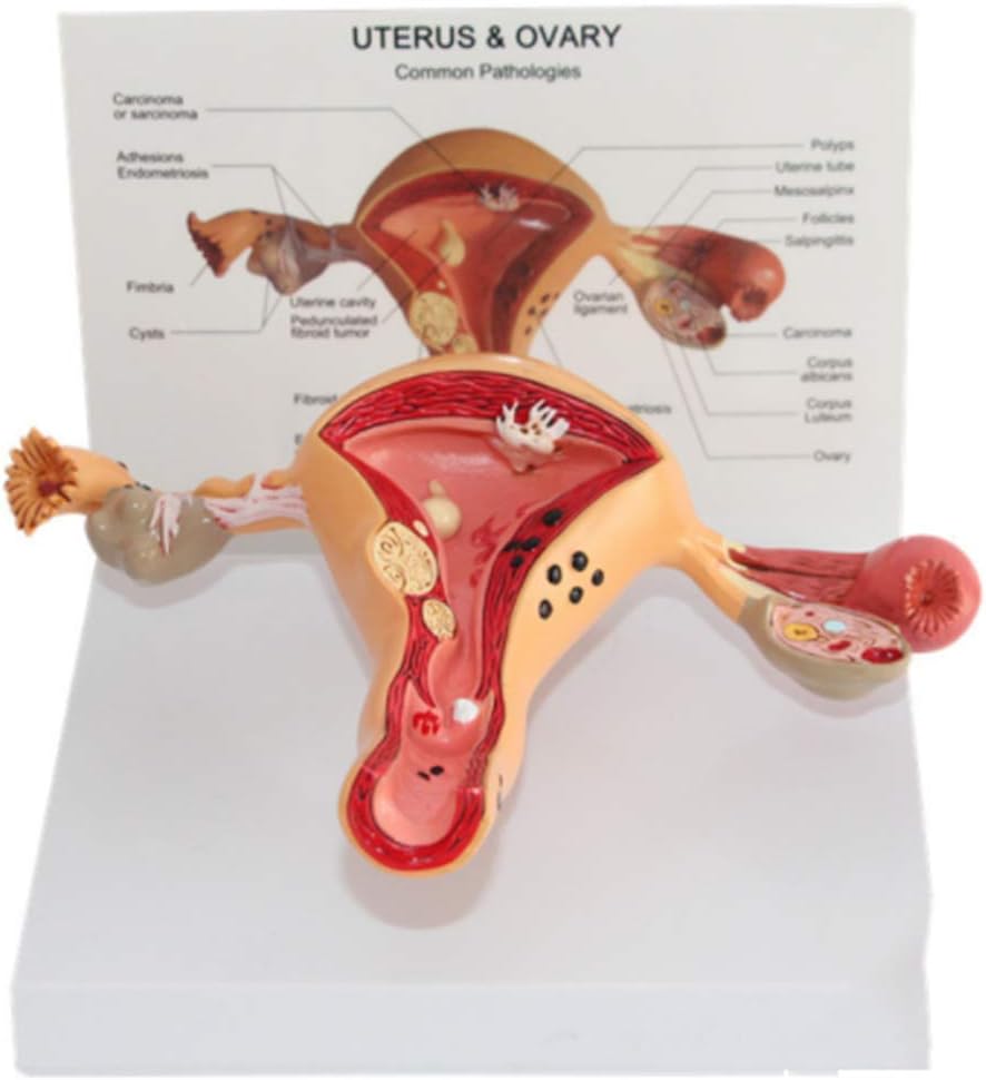 BEAGHTY Modelo anatómico del útero Humano Modelo de lesión uterina Enfermedad ovárica uterina Modelo patológico Materiales de protección Ambiental Comunicación médico-Pac