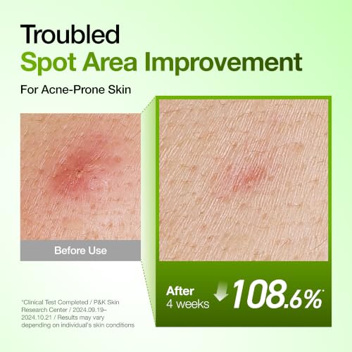 Image of Anua Azelaic Acid 10 Hyaluron Redness Soothing Serum with Cica Soothes & Calms Acne-Prone Skin