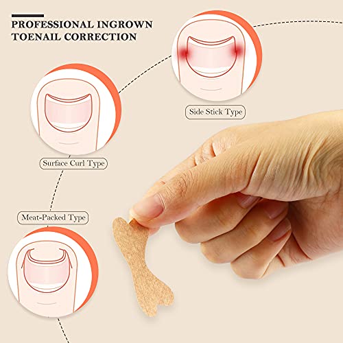 Rmisodo 120 Pieces Ingrown Toenail Correction Sticker, Adhesive Toenail Patch, Elastic Nail Treatment Corrector Sticker, Professional Foot Care Tools For Men - Keep Nails Healthy #TOP2