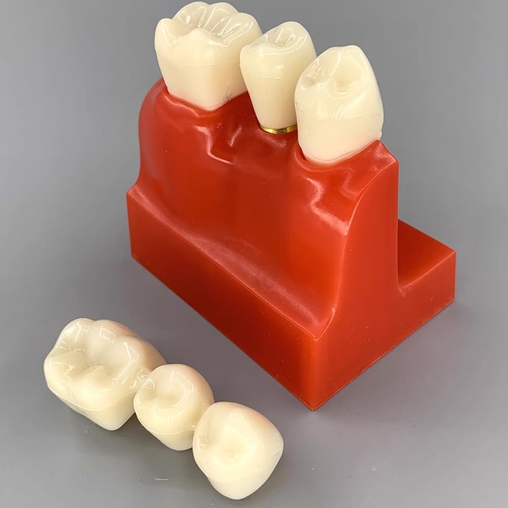 Modèle D'implant Dentaire - Modèle De Dent De Démonstration Pour Couronne Bridge Amovibles (4 Fois) - Modèle De Dent Pour L'analyse D'implants Dentaires À Des Fins D'apprentissage De Formation