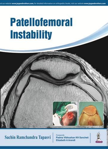 Patellofemoral Instability: Knee Joint