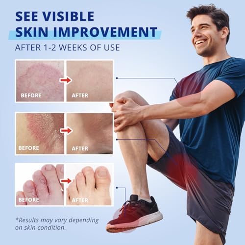 Image of Antifungal Jock Itch Cream: Extra Strength Clotrimazole Antifungal Cream - Non Steroidal - Anti Fungal Itchy Skin Relief for Itching Burning Cracking with Tea Tree Oil - Ideal for Groin Inner - 2 OZ