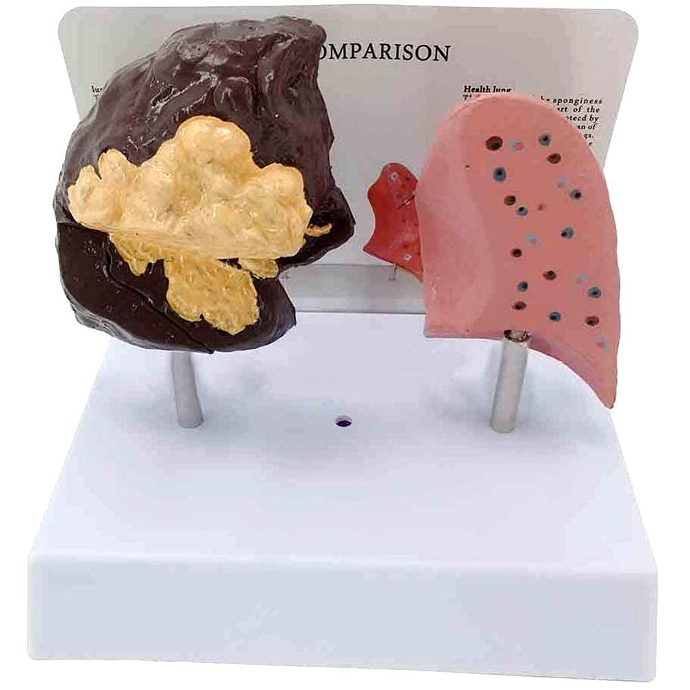 Anatomía Modelo anatómico Ensamblaje Anatómico Los pulmones Pulmón Patología Normal Modelo anatómico Aula para la educación del Paciente para la Escuela,Educación
