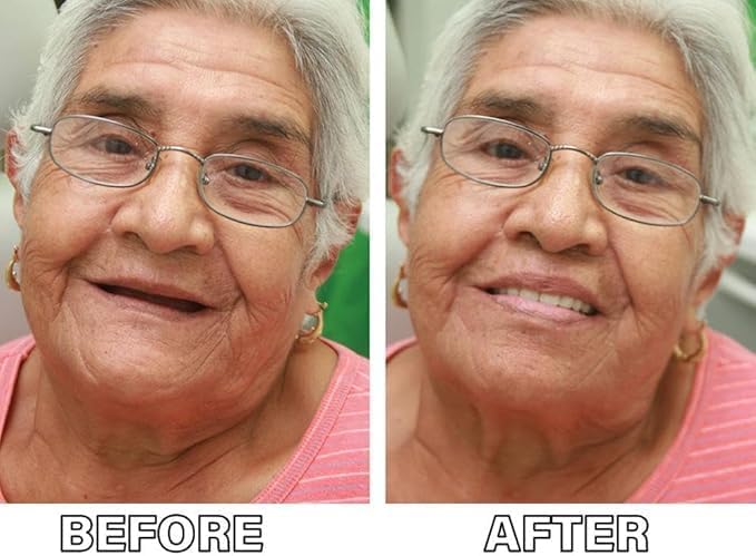 Premium Silicone Denture Reline Kit - Soft Reline Set for Secure Upper/Lower Dentures - All-Day Comfort for Men & Women