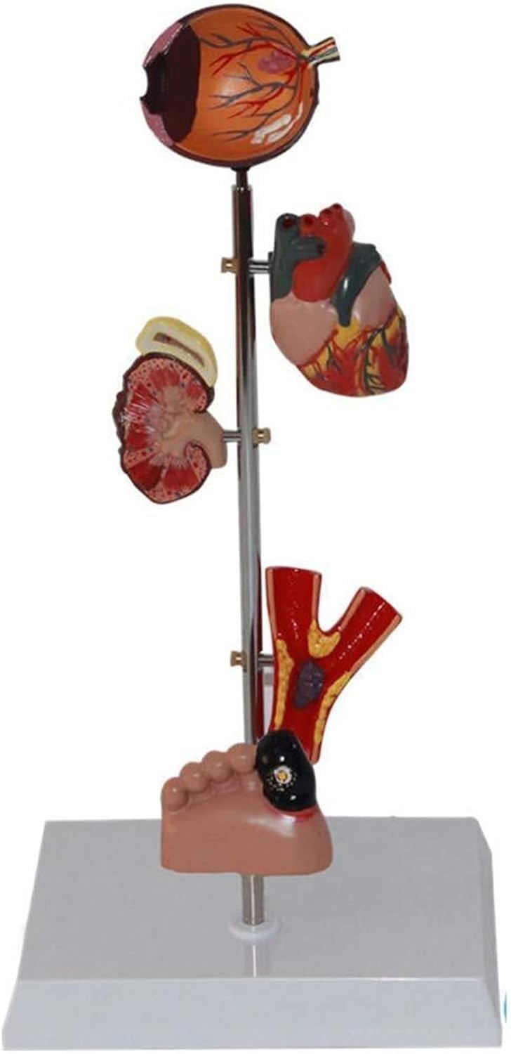 CHROX Modèle De Diabète en PVC, Modèle Humain, Modèle De Rein, Modèle D'organe, Modèle De Diabète : Œil, Rein, Système Cardiovasculaire, Modèle De Pied (avec 5 Parties Mobiles)