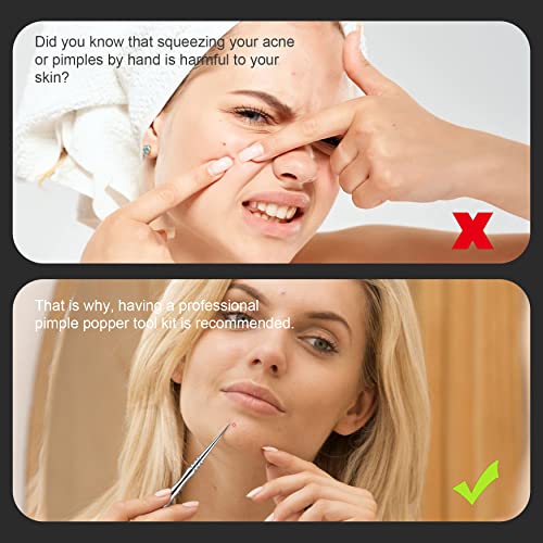 BEZOX-Blackhead-Remover-Tools-ALL-Stainless-Steel--Set-of-Blackhead-Tweezers-and-Ance-Needle-with-Comedone-Extractor-High-Temperature-Disinfection-Never-Rust--Easy-Remove-Pimples-Blackheads-Zit