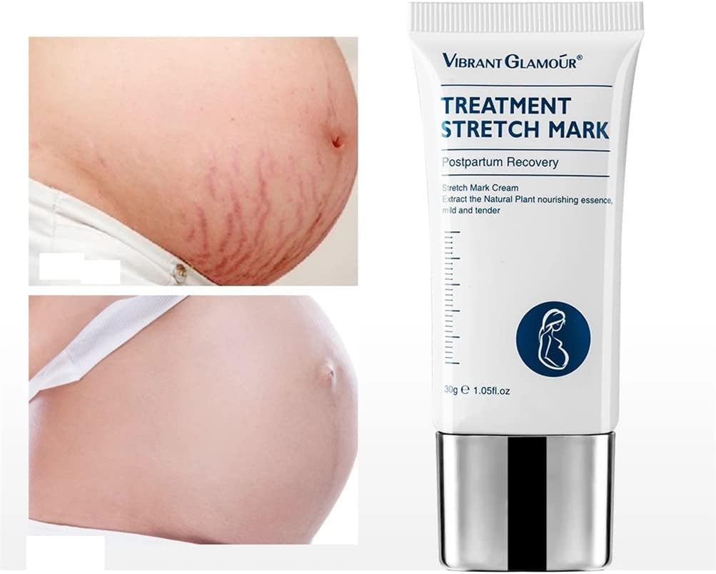 Stretch Mark Repair Cream Stretch Cream Stretch Mark Removal Acne Scar Stretch Vetstrepen Gravidarum behandeling reparatie anti-aging venster versteviging Body Care (2 stuks) Stretch Mark Repair Cream Stretch Cream Stretch Mark Removal Acne Scar Stretch Vetstrepen Gravidarum behandeling reparatie anti-aging venster versteviging Body Care (2 stuks)