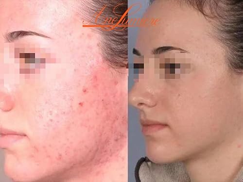 Miniatura 3 de Peeling ácido químico anti del equipo de la cáscara del acné para el tratamiento del acné de la cara 1.69oz BHA para la cáscara de la piel