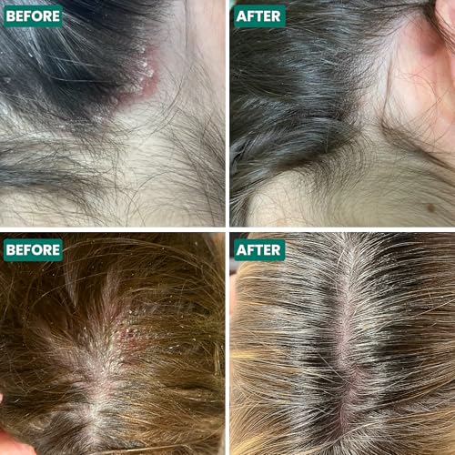 Grahams Natural Scalp Relief Cream - Seborrheic Dermatitis, Dandruff & Psoriasis Scalp Treatment - Moisturises Dry, Itchy & Flaky Scalps - Manuka Honey, Calendula, Jojoba Seed Oil (1 x 60g) - 8