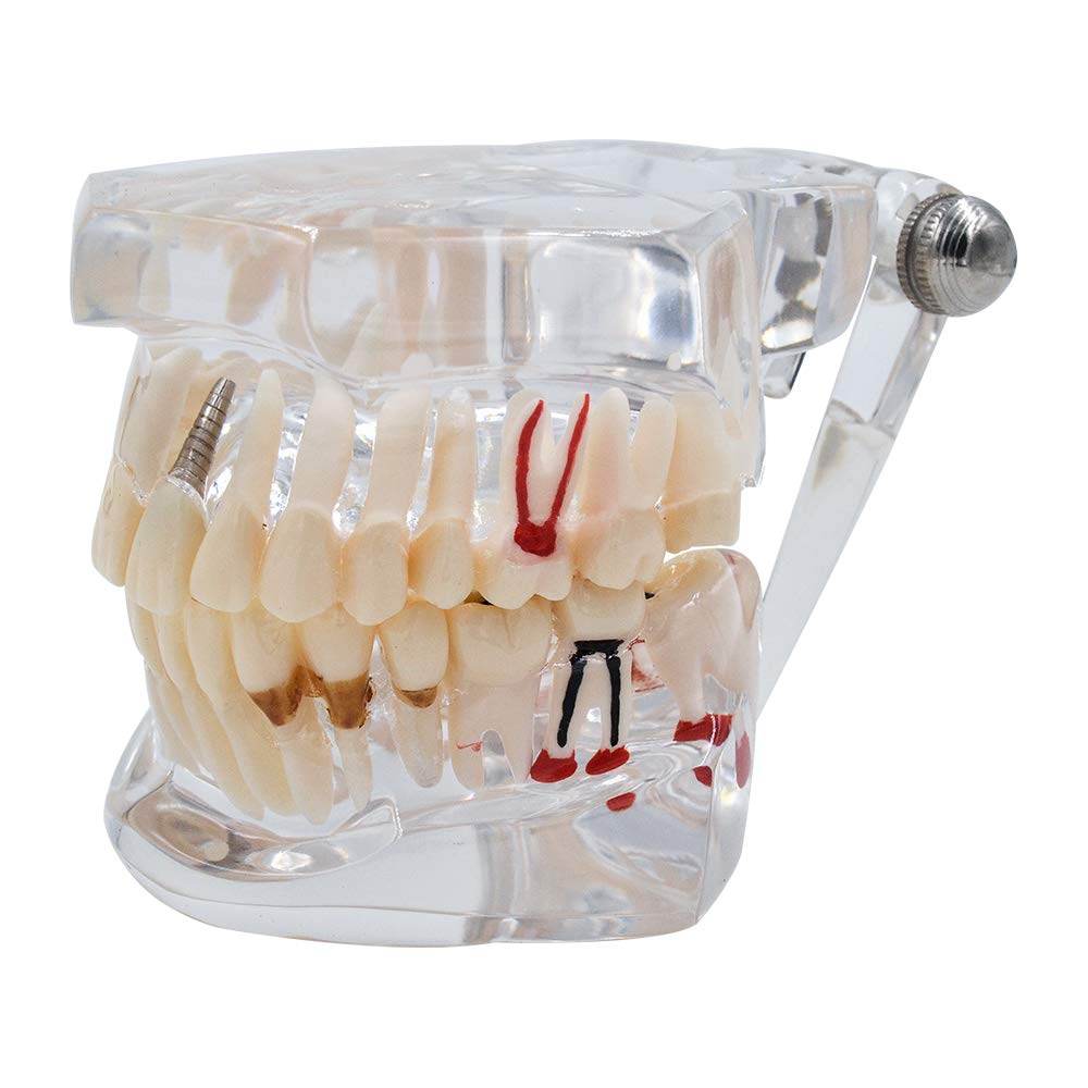 Transparent Teeth Model - Removable Adult Tooth Study Model, Typodont Pathological Disease Implant Teaching Tools