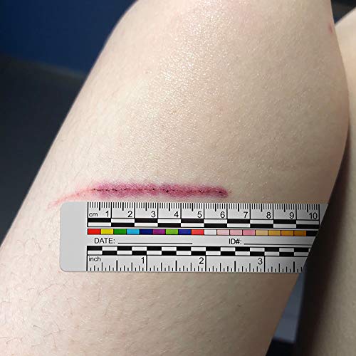 Vaxato (Pack Of 100) Self-Adhesive Wound Measurement Tools Wound Measuring Ruler Medical Ruler Wound Measuring Tool Wound Measure Sticker #TOP5