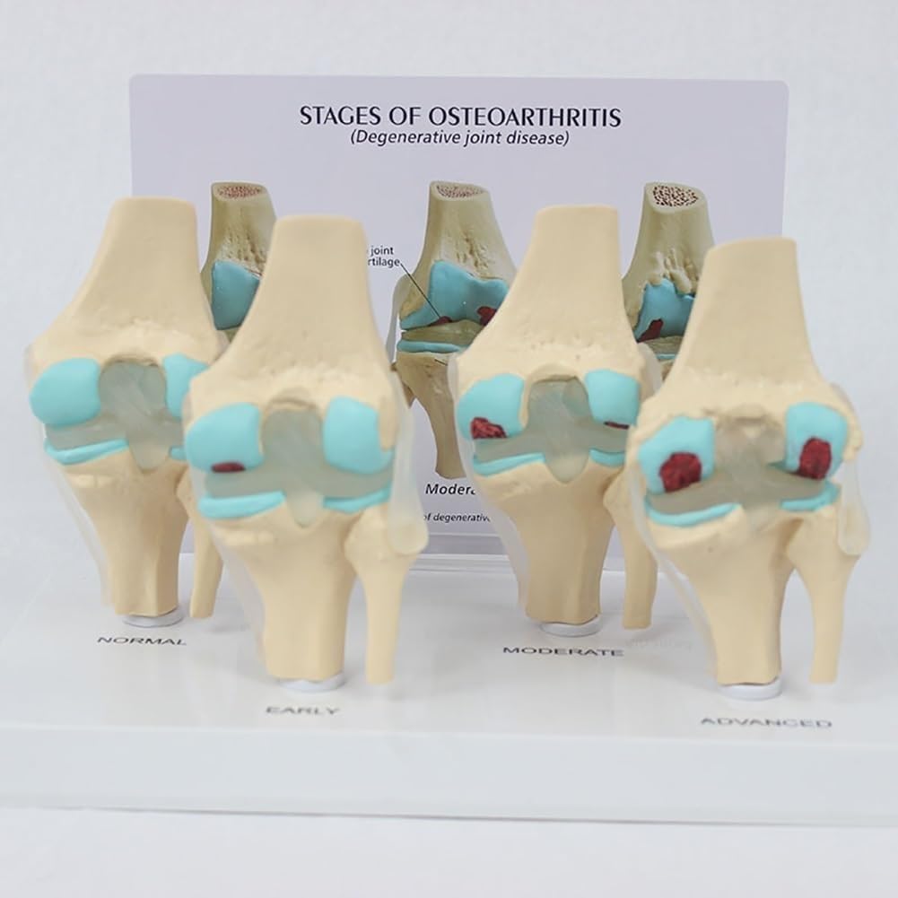 Model anatomiczny choroby zwyrodnieniowej stawów, ludzki 4 stopnie, materiał PCW z podstawą do ekspozycji edukacyjnej w klasach