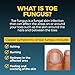 Fungi-Nails Anti-Fungal Ointment, Kills Fungus That Can Lead to Nail & Athlete’s Foot with Tolnaftate & Clinically Proven to Cure Infections, Natural Color, 0.7 Fl Oz (Pack of 2)