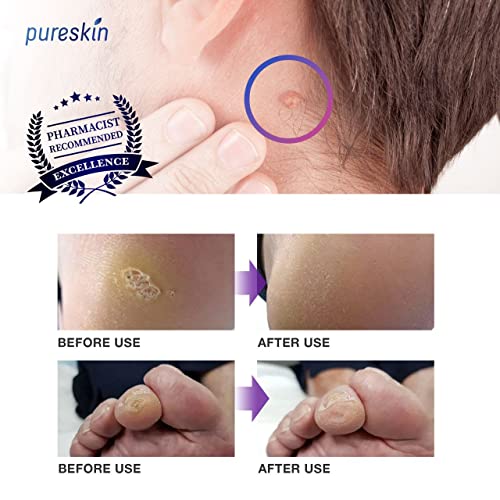 Pureskin Foot Corn Remover, Corn Removal For Toes, Corn Removers For Feet Extra Strength, Liquid Corn And Callus Remover #TOP3