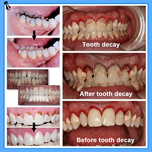 Tooth Repair Kit Includes 3 Moldable Denture, Option That Can Option That Can Easily Be Reshaped To Fit Your Missing Or Broken Teeth, Broken Teeth, Replace Missing Teeth.basics+Thermal Beads. #TOP2