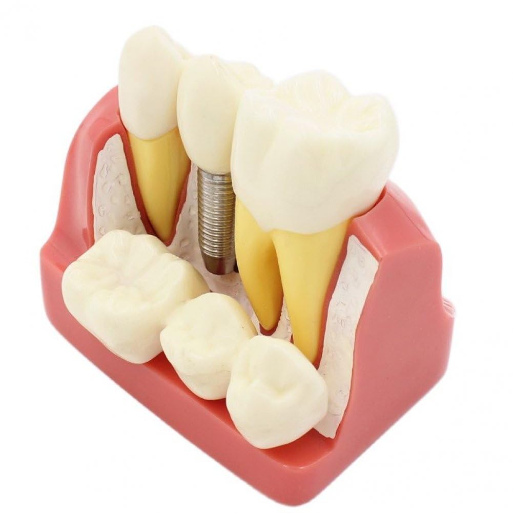 Impianto dentale: la soluzione definitiva per sostituire un dente mancante - Studio Dentistico Maini