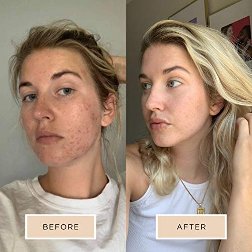 Averr Aglow Clarifying Hydration Dew, Daily Face Skin Moisturizer, Skincare Mist, Natural Vitamin Solution Treatment, Facial Moisturizer Care, Prevent Breakouts, Blackheads, & Blemishes #TOP5