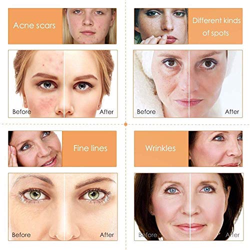 Akary Vitamin C Serum For Face, Skincare Vitamin C Serum For Dark Spots With Hyaluronic Acid And Vitamin E, Moisturizing Facial Serum Removes Dark Circles And Fine Lines For All Skin Type #TOP5