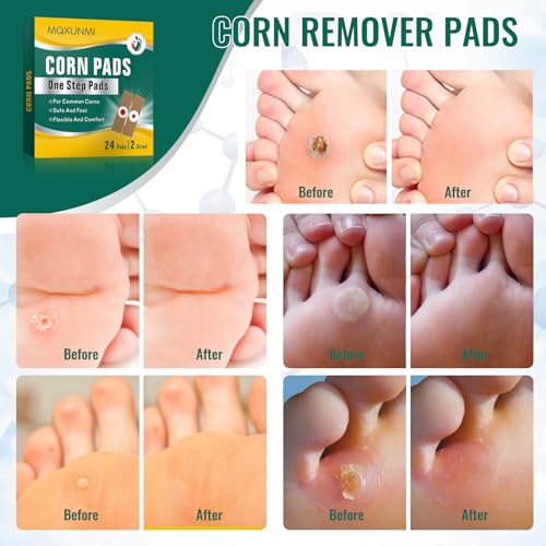 Hühneraugen Pflaster, MQXUNMI 24Pcs HühneraugenPflaster, 2-Größe Hühneraugen Entfernen für Füße, Hühneraugen Entferner und Hornhaut, Corn Remover Pads Hühneraugen-Entfernung