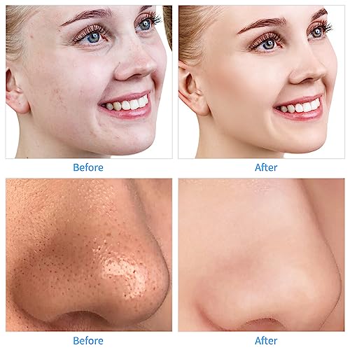 mcwdiot Diamond Microdermabrasion Kit