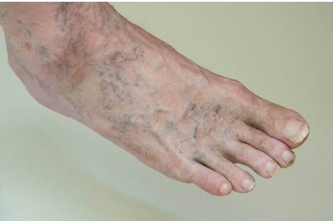 Venaclose Management Of Chronic Swollen Veins, Spider Veins | Deep