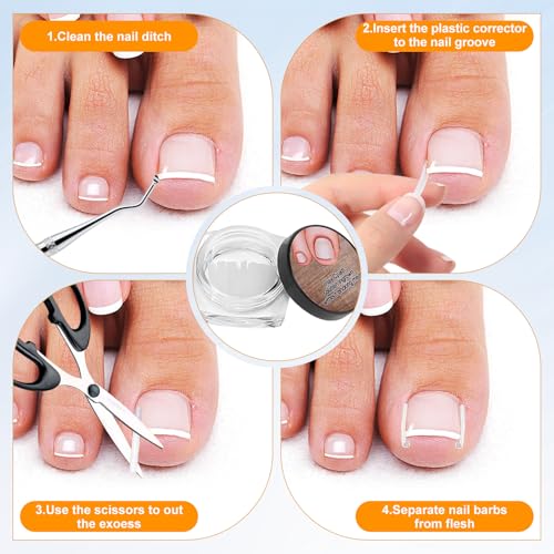 Ingrown Toenail Corrector Set with Correction Strips, Ingrown Toenail Removal Kit, Professional Ingrown Toenails Pedicure Tool Set (Silver) — view 5