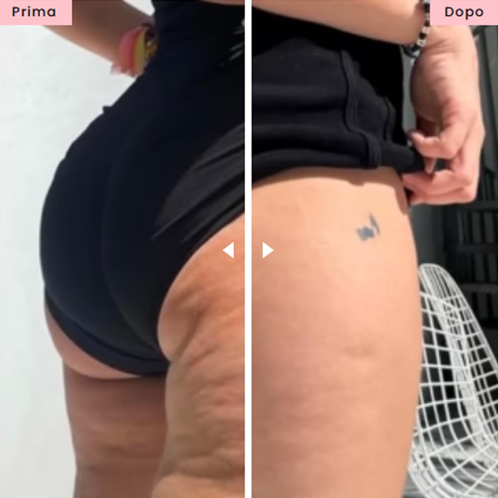 Massaggiatore Anti Cellulite, Beauty AntiCellulite Massaggiatore - Tonifica, Drena, Rassoda, Fai Pace Con La Tua Pelle, Una Volta per Tutte (Bianco)