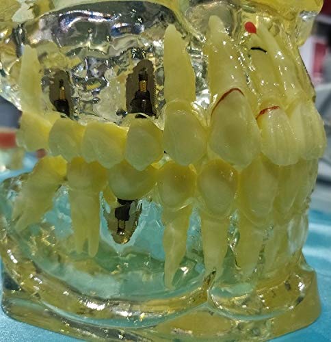 Healix All in One Model for Patient Education Healix All in One Model for Patient Education