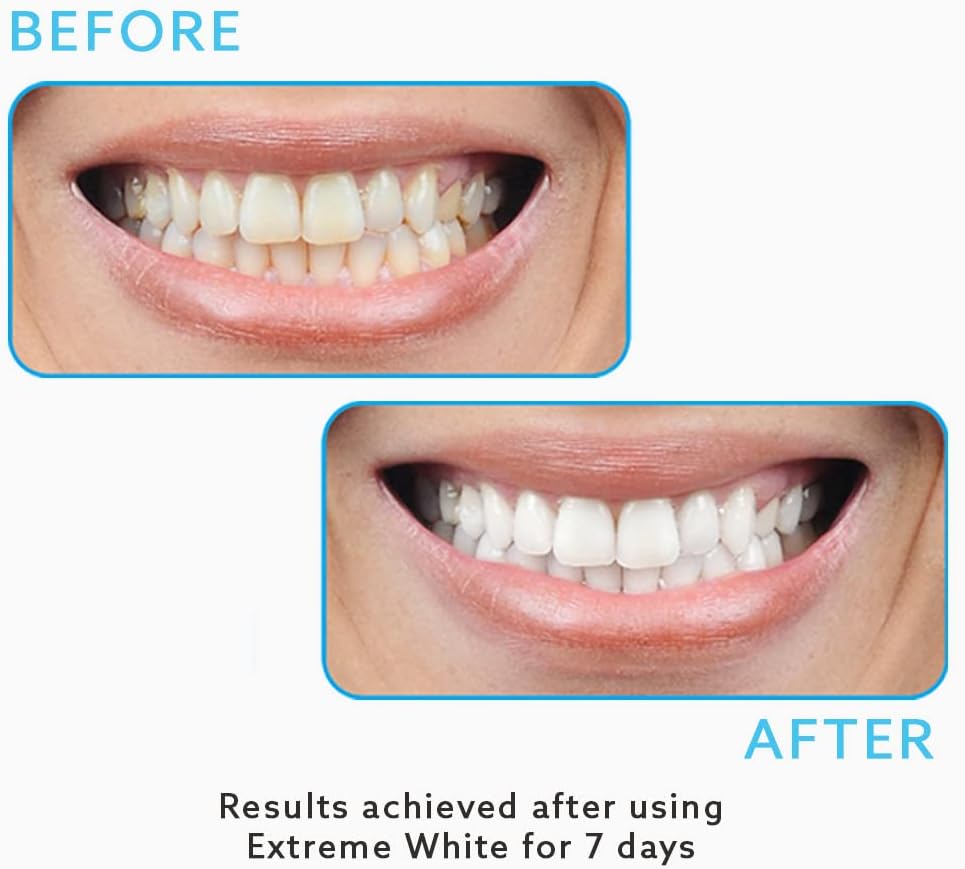GO SMILE Super White Professional Teeth Whitening System (14 single-use, applicators), Clinically proven up to 7 shades whiter in a week, Dentist Recommended, Professional strength, Award-Winning Be