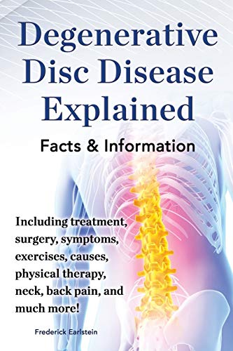 Degenerative Disc Disease Explained. Including Treatment, Surgery, Symptoms, Exercises, Causes,...