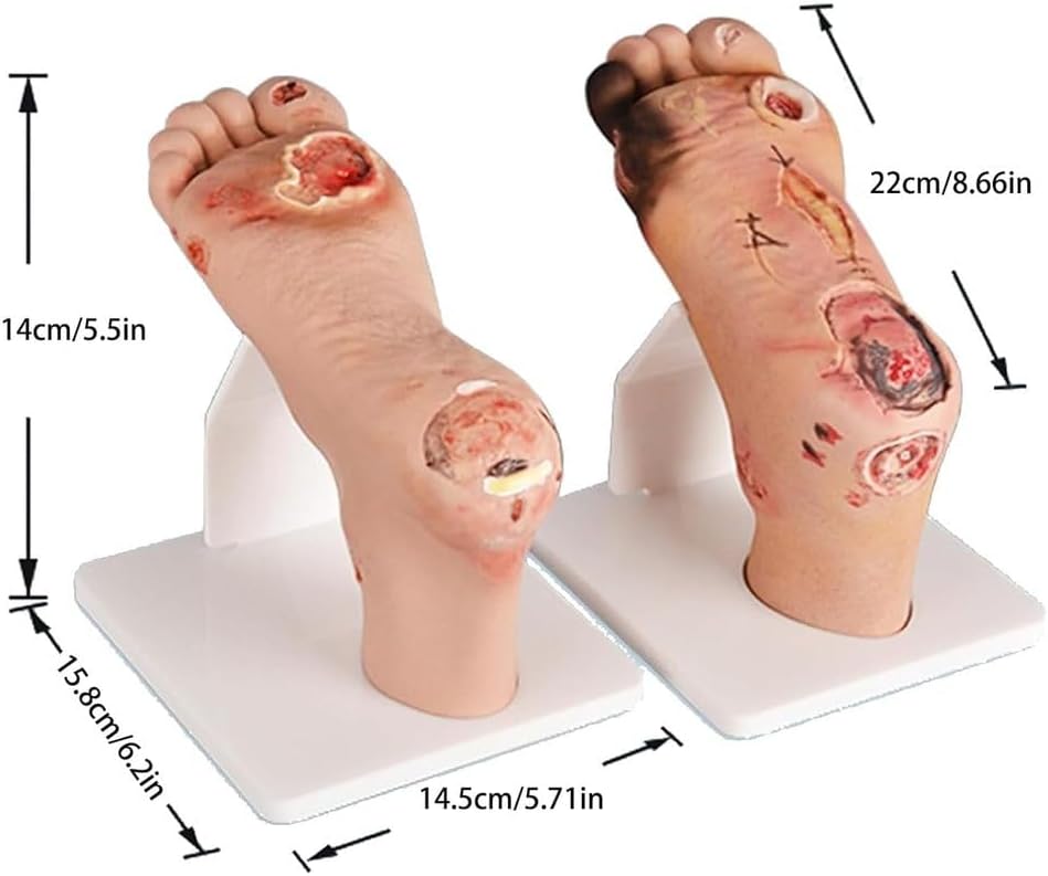 Teaching Model,Diabetic Foot Ulcer Model Set - Anatomical Accuracy for Mild & Severe Stage Pathology Study-Medical Training Tool for Healthcare Professionals