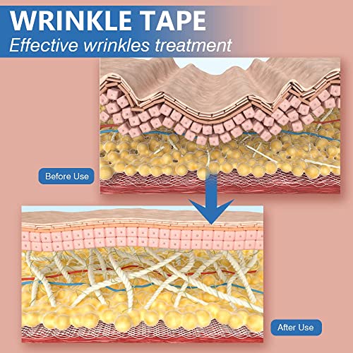 Zornesfalte Pflaster Sfuchin Face Lifting Tape Multifunktionale Anti-Falten Lösung