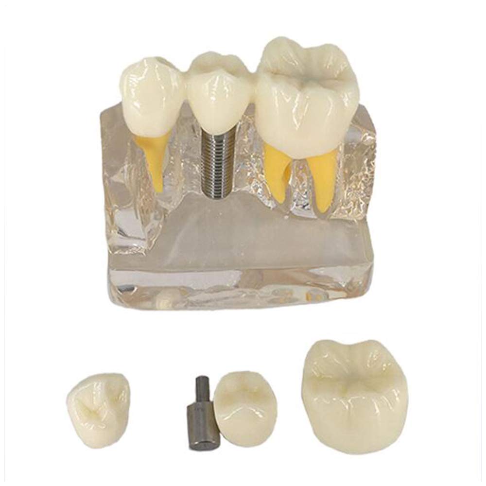 Resin Dental Implant Model - Dental Zähne Modell Bildung Zähne Modell - Crown Brücke Demonstration Zähne Gums Zahnpflege Unterricht Study Typodont Modell