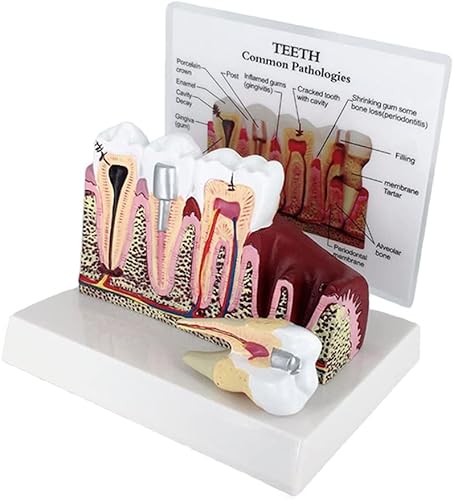 Modelo dental Anatomía del cuerpo humano Modelo de anatomía de dientes desmontables Modelo de enseñanza médica Modelo de diente dental Réplica de