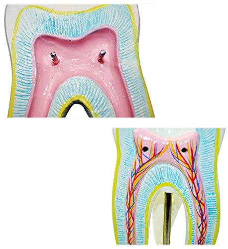 Modelo Dental - Tallada Herramientas De Demostración Modelo De La Caries Dental como Un Modelo De Aprendizaje O Una Herramienta De Investigación