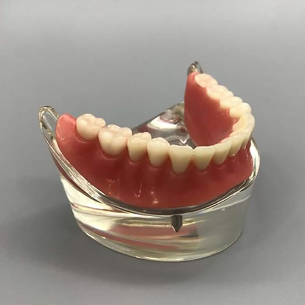 Modelo Dental - Modelo de Dientes de Implantes Dentales- Sobredentadura Dental Mandibular Inferior 2 Implantes Demo para Enseñar y Estudiar