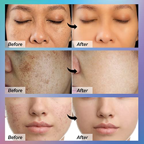 Dark Spot Remover For Face,Dark Spot Corrector Serum,Hyperpigmentation Treatment,Advanced And Natural Formula - - Removes Freckles, Sun Spots, Melasma And More, #TOP6