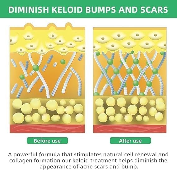 Image of Keloid & Scar Removal Gel - Advanced Silicone Scar Treatment Cream | Fades Acne, Surgery, Injury & Piercing Scars | Smoothens Skin, Reduces Bumps & Marks | 30g Scar Repair Solution (1)