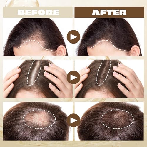 Siero Crescita Capelli, Fluido Per La Crescita Dei Capelli, Promuove La Crescita E La Densità, Nutre Il Cuoio Capelluto, Adatto A Tutti I Tipi Di Capelli, Adatto A Uomini E Donne - 2