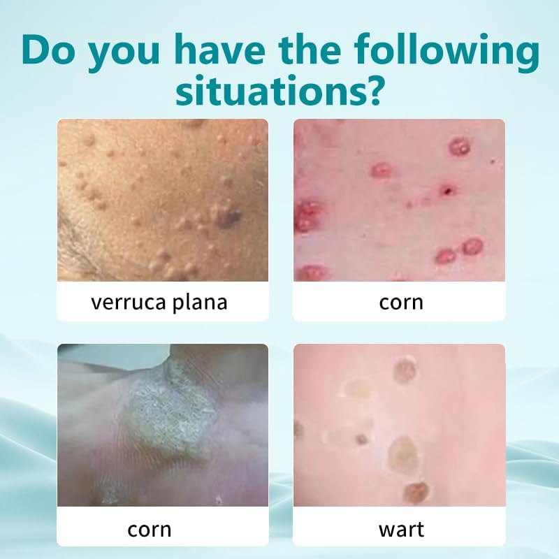 Miniatura 4 de Eliminación de acción rápida para hombres y mujeres, congelación de verrugas para verrugas plantares, verrugas comunes, verrugas planas, maíz