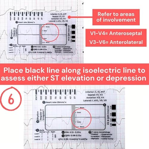 Regla ECG 7 Pasos Transparente de Plástico para Interpretar ECG miniatura 6
