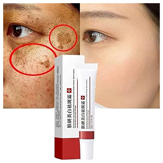 Crema blanqueadora para pecas, crema de tratamiento para eliminar cicatrices de acné, crema para eliminar pigmentaciones para la cara, elimina manchas oscuras, hidratante elimina el melasma facial,