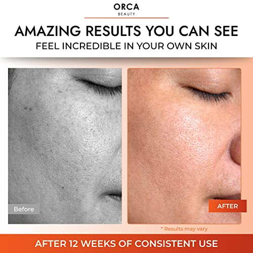 Vitamin C Serum For Face With Hyaluronic Acid Vitamin C Skin Serum Vitamin C Face Serum, Serum Vitamina C Para El Rostro Serum - Face Vitamin C Serum, Vitamin C Facial Serum, Vit C Serum #TOP5